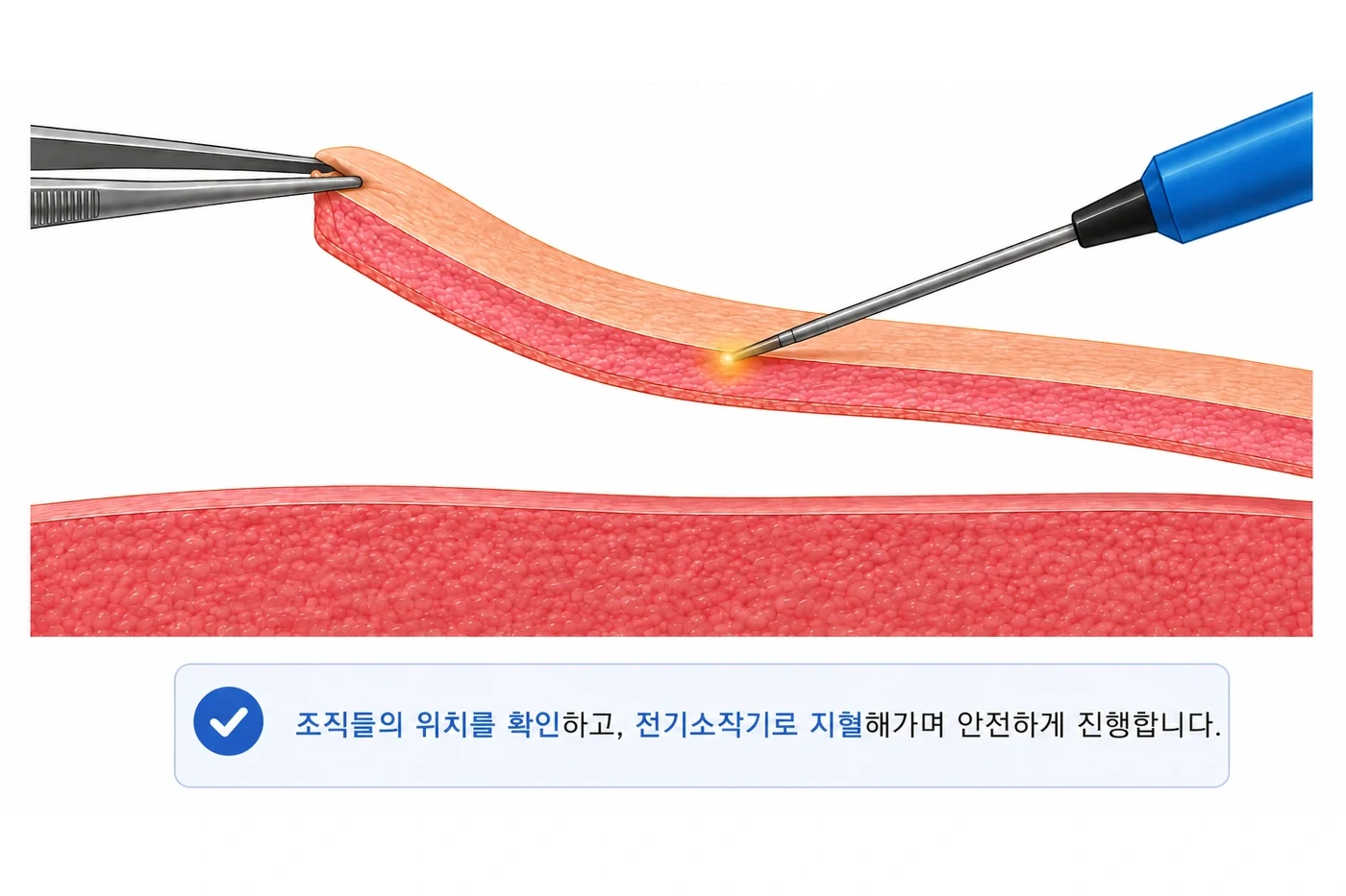 조직 위치를 확인하며 전기소작기로 절제와 지혈을 진행하는 단면 도식