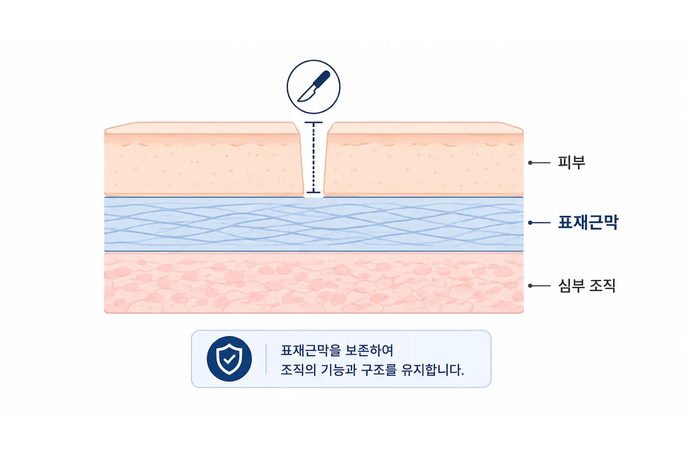 피부 아래 표재근막과 심부 조직의 층을 구분한 보존 수술 도식